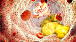 Understanding the Role of Lipoprotein(a)